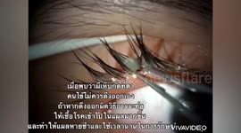 Girl, 13, has tick from a pet dog removed from her eyelid in Thailand