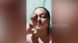 Filipina woman lives with large eye tumor