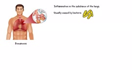 Pneumonia [Overview] - Causes, Types, Signs & Symptoms, Diagnosis & Treatment [Patient Education]