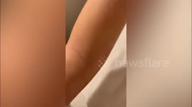 UK woman left paralysed after contraceptive implant gets STUCK in her arm