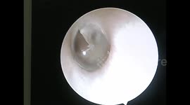 Cockroach gives birth in man's ear