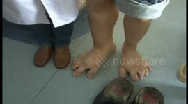 Man with giant feet receives foot surgery