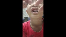 The boy's mother used a string to help him pull out his teeth quickly