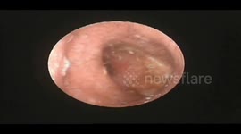 Dozens of fly larvae found in man's ear