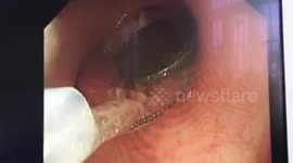 Toddler gets windpipe stuck by apple and finds a coin in stomach