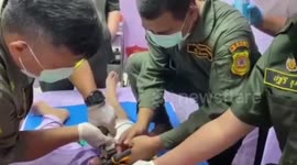 Thai man with metal ring stuck on penis for FOUR MONTHS to increase size finally has it removed