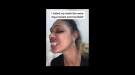 Before and after: London woman goes to Turkey to fix what she called 'horrific' teeth