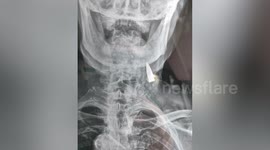 Chinese war veteran, 95, shocks medics with bullet stuck in his neck 'for more than 77 years' (pictures)