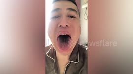 Chinese man with COVID-19 contracts black hairy tongue syndrome