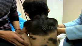 One-year-old boy with rare medical condition has 'fur' growing on his back