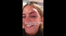Bride hit with BASEBALL in face days before wedding walks down aisle with BLACK EYE