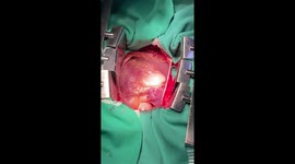Adult men heart beating during open chest heart surgery. video for studying anatomy and knowledge purposes