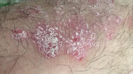 Psoriasis, Plaque psoriasis, Pustular psoriasis, Inverse psoriasis, Napkin psoriasis,  Guttate psoriasis, Erythrodermic psoriasis