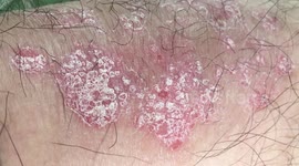 Psoriasis, Plaque psoriasis, Pustular psoriasis, Inverse psoriasis, Napkin psoriasis,  Guttate psoriasis, Erythrodermic psoriasis
