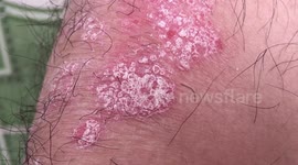 Psoriasis, Plaque psoriasis, Pustular psoriasis, Inverse psoriasis, Napkin psoriasis,  Guttate psoriasis, Erythrodermic psoriasis