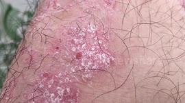 Psoriasis, Plaque psoriasis, Pustular psoriasis, Inverse psoriasis, Napkin psoriasis,  Guttate psoriasis, Erythrodermic psoriasis