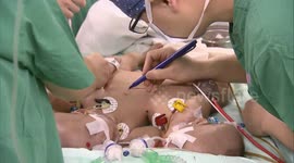 计算机3D成像术中导航 联体男婴分离手术成功