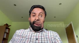 Man with facial disfiguration left 