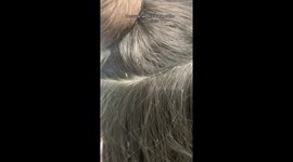 Woman finds 150 lice eggs living on scalp!