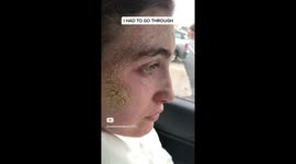 MEET THE WOMAN who was left mystified after a huge weeping eczema scab appeared on her cheek after bungling medics prescribed topical steroid cream but was rescued from her condition after her plea for help on TikTok led to an avalanche of support.