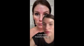 THIS WOMAN was left with melasma, sun spots, freckles and discolouration after using sunbeds and sun exposure but now tells you the secrets to having perfect skin.