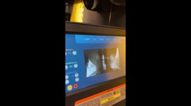 Man spends £64,000 on limb-lengthening surgery after being 'rejected' by women for being 'too short' – he's now half a FOOT taller PART 3/4