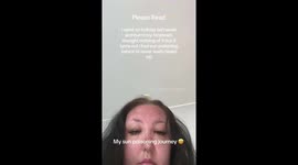 Woman's relaxing getaway turns into NIGHTMARE as sun poisoning leaves her unrecognisable