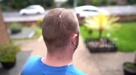 Man left with half his skull missing following assault has it rebuilt with plastic