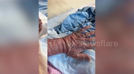 Woman lost all her hair after through severe Topical Steroid withdrawal after ditching steroid creams