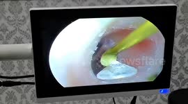 Chinese woman finds missing earring diamond in ear during routine clean