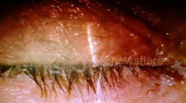 Woman drips super glue into her eyes instead of eye drops