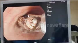 Devotee has religious amulet removed from his throat after swallowing it during ceremony