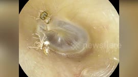 Woman, 64, with ear pain shocked to find spider living inside