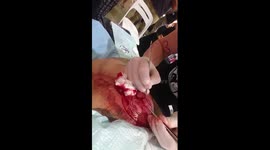 Man gets heart shape scarified onto his chest