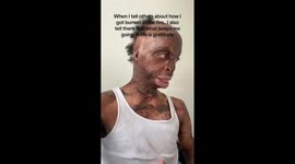 ‘I have burn scars on 90% of my body – my love life is non-existent' (Pt 1)