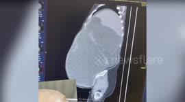 Woman has giant ovarian tumour weighing 30 kilogrammes removed after living with it for 10 years