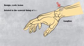 Ganglion Cyst - Surgery Short Cases