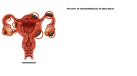 Endometriosis - Causes, Risk Factors, Signs & Symptoms |What Is Endometriosis?