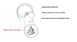 Prolactinoma - Causes, Risk Factors, Signs & Symptoms, Diagnosis, And Treatment