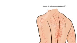 Immune Thrombocytopenic Purpura (ITP) - Causes, Pathogenesis, Signs & Symptoms, Diagnosis, Treatment
