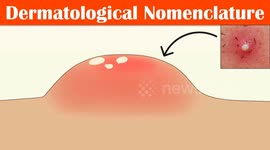 Describing Skin Lesions (Dermatological Nomenclature) - Macule, Papule, Pustule, Vesicle & Others