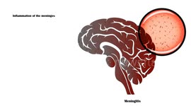 Meningitis - Signs & Symptoms |Most Common Signs & Symptoms Of Meningitis
