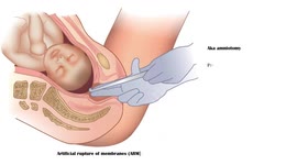 Induction Of Labor - Artificial Rupture Of Membranes (Amniotomy) -