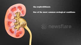 Kidney Stones (Nephrolithiasis/Urolithiasis) - Causes, Types, Signs & Symptoms |Urinary Stones