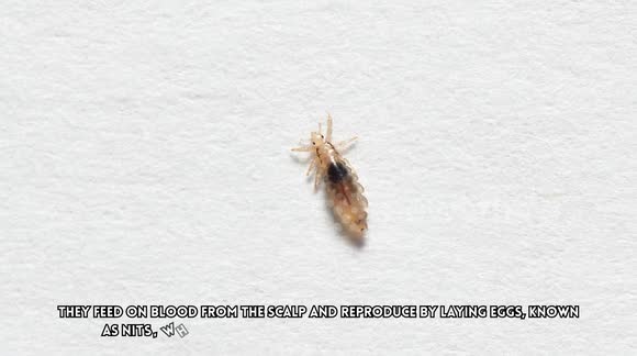 Head Lice Infestation - Causes, Signs And Symptoms, Diagnosis, And ...