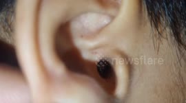 Doctors remove ticks that crawled into boy's ears