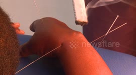 Chinese acupuncture works wonders for Zimbabweans