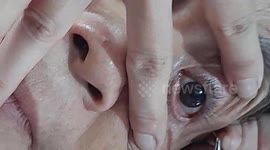 The doctor removed the 5 cm long parasitic tapeworms in the woman's eyes