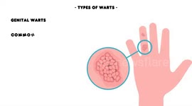 Warts - Different Types, Causes, Signs & Symptoms, And Treatment