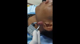 Bungling patient puts padlock through ear but cannot unlock